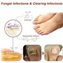 Traitement Champignons Ongles