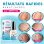 Traitement Mycoses ongles des pieds et mains 12 ml - Traitement Professionnel Vernis Mycose Ongles Pied et restaure l'aspect nat