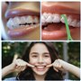 8 Pièces outils de retrait d'aligneur invisibles pour enlever les dents Aligner les dents Crochet de dentition Correcteur buccal