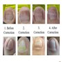 Young21 Clip De Redressement D'Ongle Incarné Outil De Correction De Paronychie Épaisse BS Brace Toenails