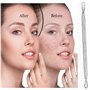Glamified, glam Extracteur de points noirs professionnel pour soins de la peau, outil de retrait des points noirs pour les imper