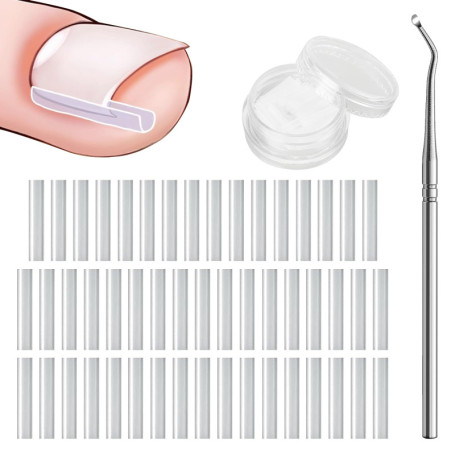 WOLMIK Lot de 40 correcteurs d'ongles incarnés sans douleur avec rehausseur d'ongles incarnés - Kit d'outils faciles à utiliser