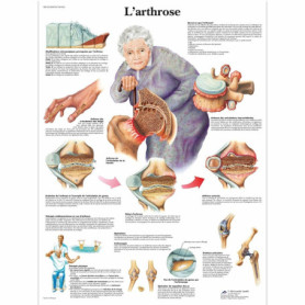 Poster Laminé sur l'Arthrose - Anatomie et Pathologie pour Enseignement