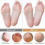 Alaoo Râpe à Pieds,Lime Pour Pieds Professionnelle Exfoliation des Peaux Mortes pour Éliminer Callosite,Réparateur de Pieds en A