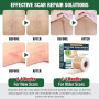 Cyberwork Rouleau de Pansement en Silicone pour Cicatrices (4CM x 150CM), Bandage Professionnel pour Soin des Cicatrices, Adapté