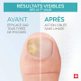 PODERM Sérum Mycose Ongles des Pieds & Mains - 8 ML | Élimine la Mycose et Régénère l’Ongle | Traitement Antifongique - Agit dès